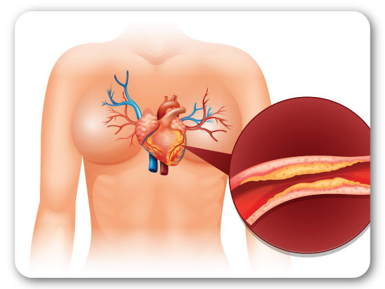 best-ivc-filters-treatment-in-Mahabubnagar