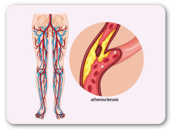 Dr-Pranoy-best-treatment-for-peripheral-artery-disease