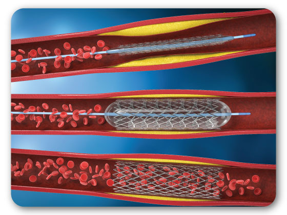 best-primary-angioplasties-treatment-in-Mahabubnagar