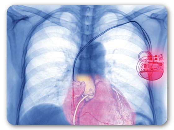 best-temporary-permanent-pacemakers-treatment-in-Mahabubnagar